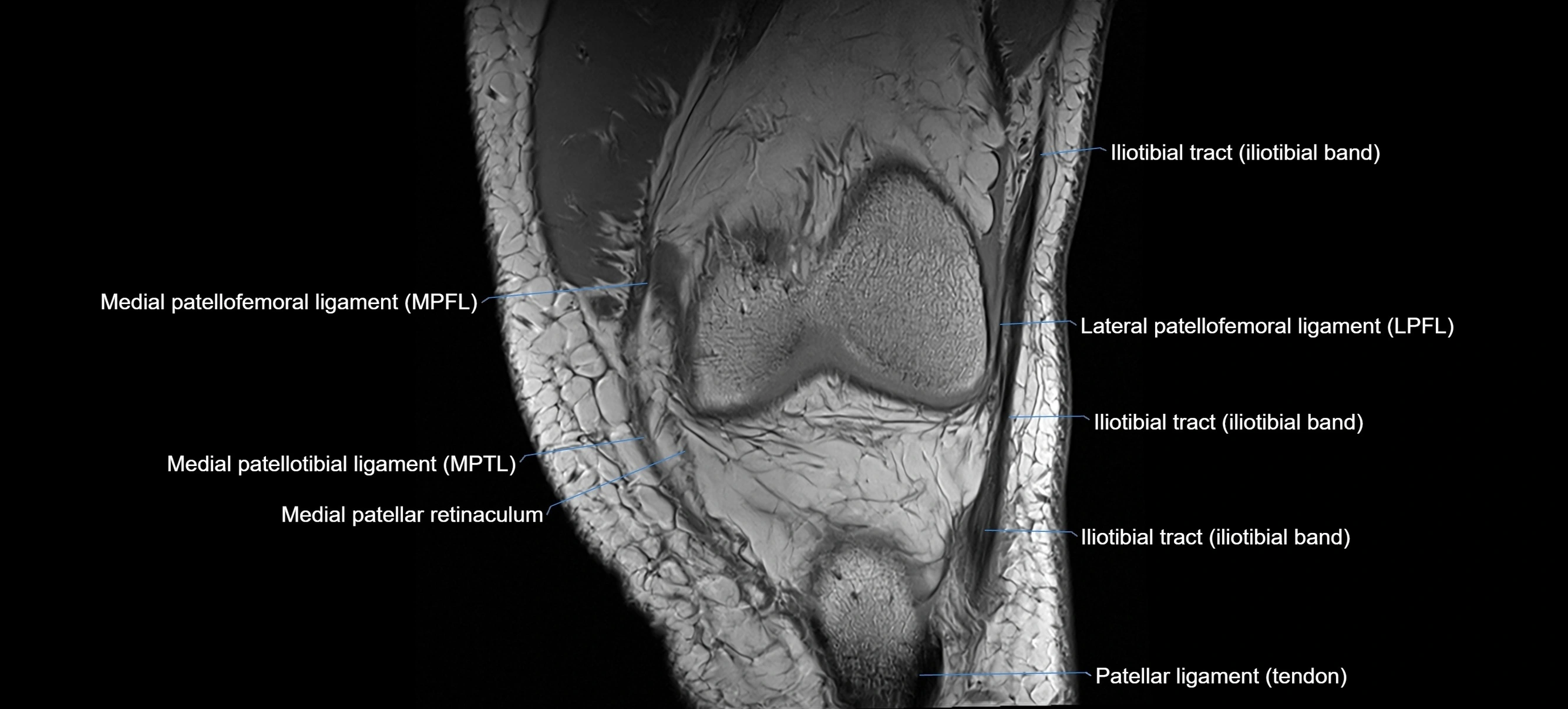 MRI coronal  ligaments cross sectional anatomy 3T  radiology  image-img-04001-00011.webp
